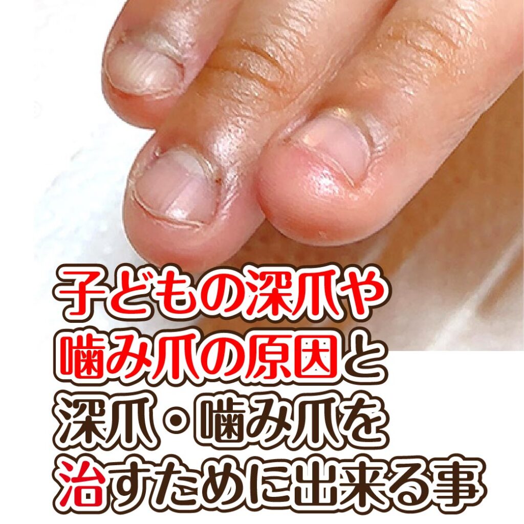 男子小学生 爪噛み ブログ 子どもの深爪や噛み爪癖の原因と深爪・噛み爪を治すため親が出来る事〜私の息子も爪噛みっ子でしたがコレで治りました |  大阪吹田|豊中|箕面|茨木|北摂地域の深爪専門ネイルサロン Smile nico【スマイルニコ】
